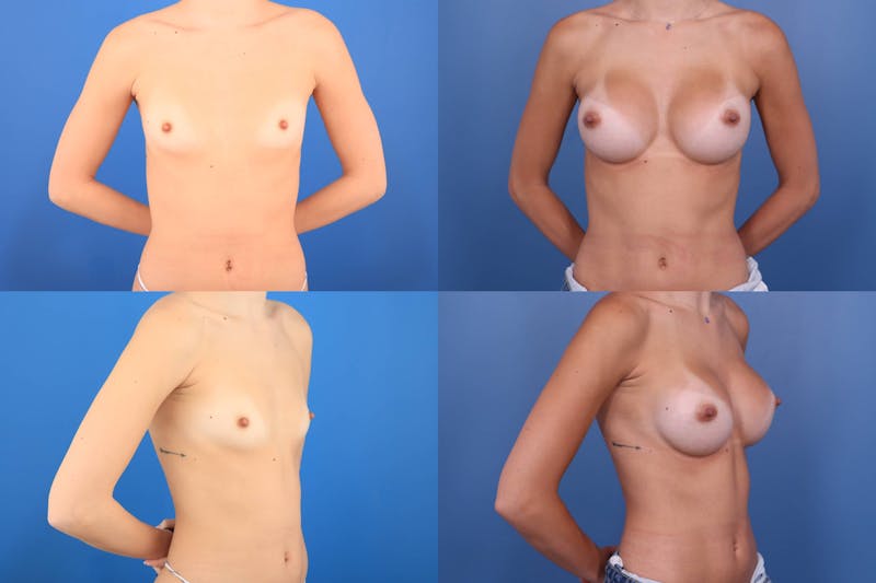 Dr. Francis Breast Augmentation Before & After Gallery - Patient 155952806 - Image 1