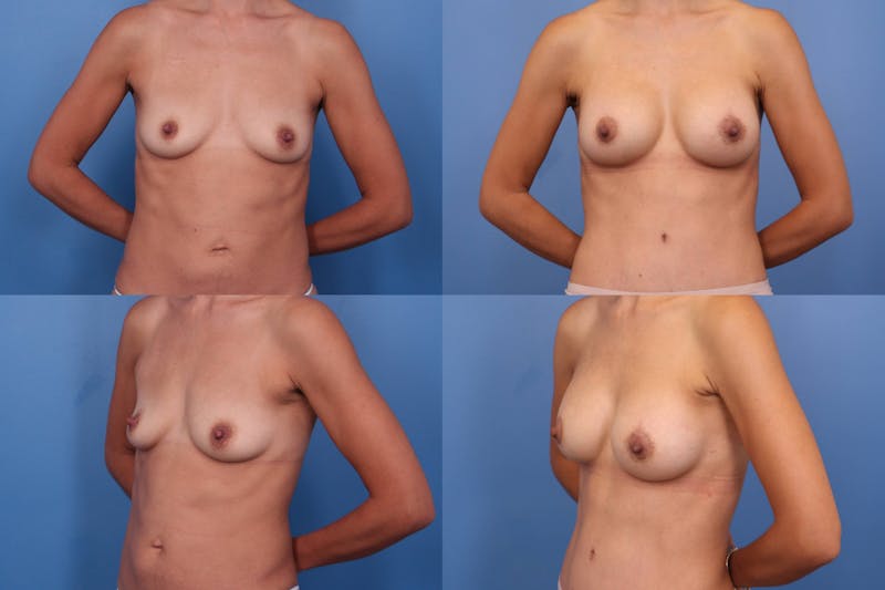 Dr. Francis Breast Augmentation Before & After Gallery - Patient 155952816 - Image 1