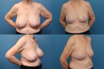 Dr. Francis Breast Implant Removal Before & After Gallery - Patient 155952821 - Image 1