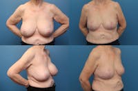 Dr. Francis Breast Implant Removal Before & After Gallery - Patient 155952821 - Image 1
