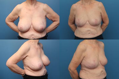 Dr. Francis Breast Lift Before & After Gallery - Patient 155952848 - Image 1