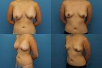 Dr. Francis Breast Implant Removal Before & After Gallery - Patient 155952822 - Image 1