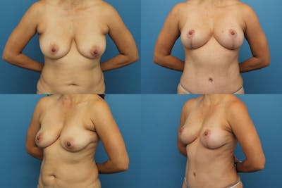 Dr. Francis Breast Lift Before & After Gallery - Patient 155952845 - Image 1