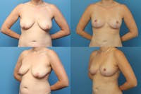 Dr. Francis Breast Lift Before & After Gallery - Patient 155952846 - Image 1