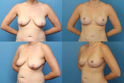 Dr. Francis Breast Lift Before & After Gallery - Patient 155952846 - Image 1