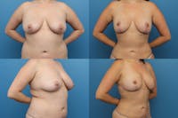 Dr. Francis Breast Lift Before & After Gallery - Patient 155952847 - Image 1