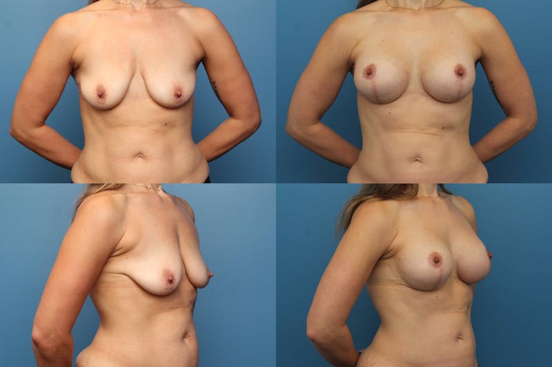 Dr. Francis Breast Lift with Implants Before & After Gallery - Patient 155952862 - Image 1