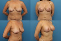 Dr. Francis Breast Lift with Implants Before & After Gallery - Patient 155952865 - Image 1