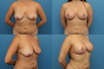Dr. Francis Breast Lift with Implants Before & After Gallery - Patient 155952865 - Image 1