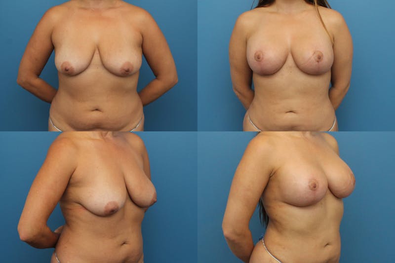 Dr. Francis Breast Lift with Implants Before & After Gallery - Patient 155952865 - Image 1