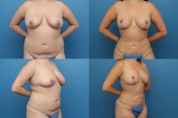 Dr. Francis Breast Reduction Before & After Gallery - Patient 155952896 - Image 1