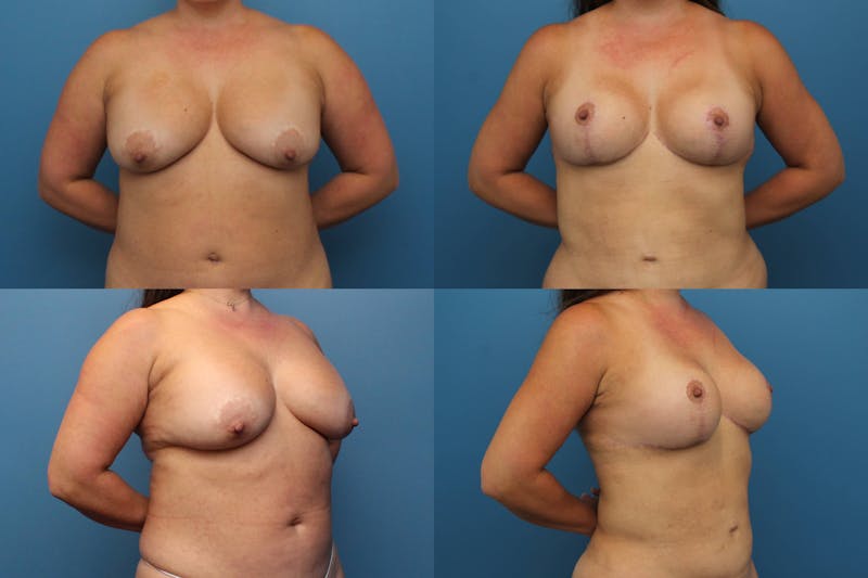 Dr. Francis Reductive Augmentation of the Breast Before & After Gallery - Patient 155952966 - Image 1