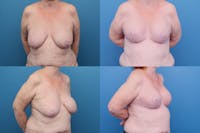 Dr. Francis Reductive Augmentation of the Breast Before & After Gallery - Patient 155952967 - Image 1