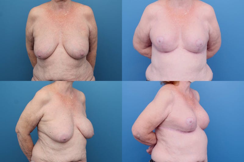 Dr. Francis Reductive Augmentation of the Breast Before & After Gallery - Patient 155952967 - Image 1