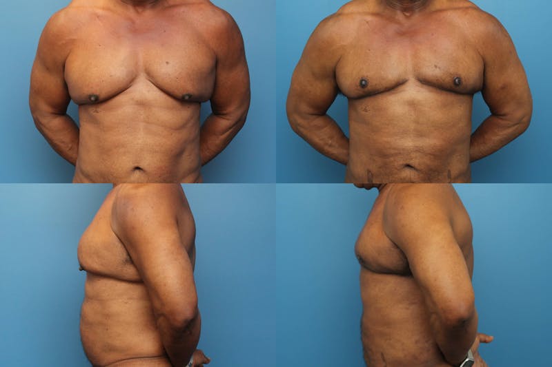 Dr. Francis Gynecomastia Repair Before & After Gallery - Patient 155952944 - Image 1
