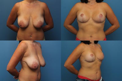 Dr. Francis Reductive Augmentation of the Breast Before & After Gallery - Patient 155952964 - Image 1