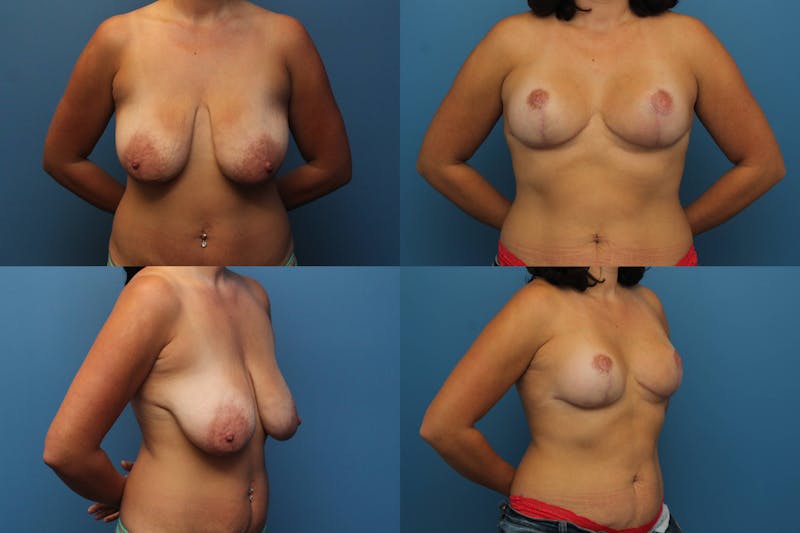 Dr. Francis Reductive Augmentation of the Breast Before & After Gallery - Patient 155952964 - Image 1