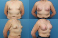Dr. Francis Tuberous Breast Correction Before & After Gallery - Patient 155953032 - Image 1