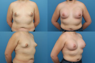 Dr. Francis Tuberous Breast Correction Before & After Gallery - Patient 155953032 - Image 1