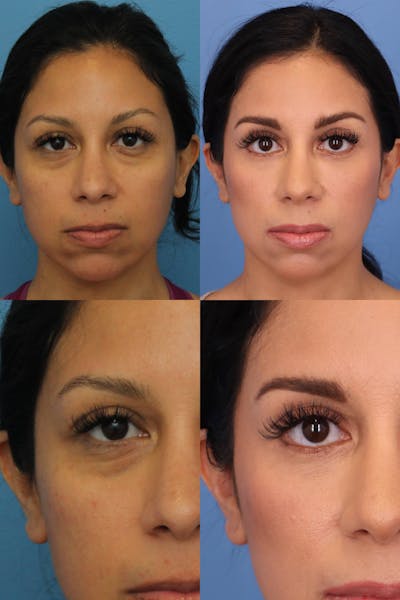 Dr. Francis Blepharoplasty Before & After Gallery - Patient 156740290 - Image 1
