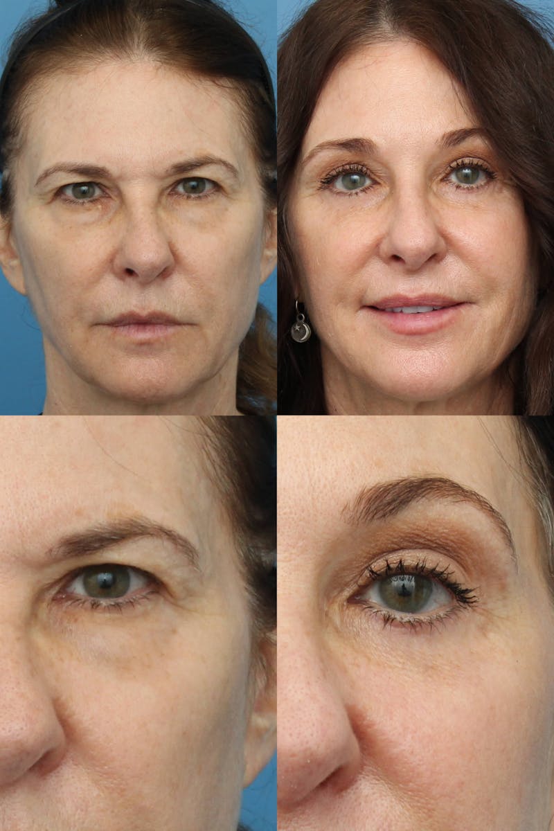 Dr. Francis Blepharoplasty Before & After Gallery - Patient 156740291 - Image 1