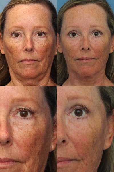 Dr. Francis Blepharoplasty Before & After Gallery - Patient 156740292 - Image 1