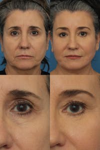 Dr. Francis Blepharoplasty Before & After Gallery - Patient 156740293 - Image 1