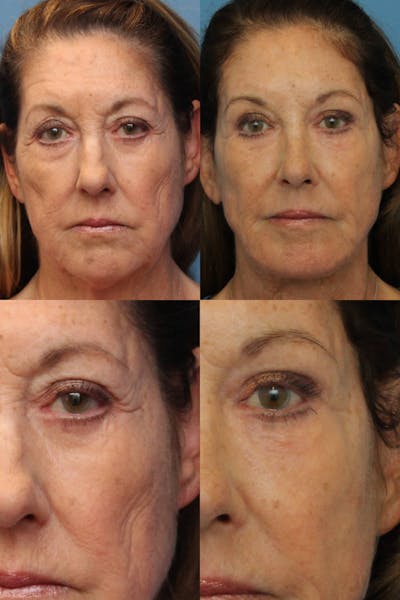 Dr. Francis Blepharoplasty Before & After Gallery - Patient 156740294 - Image 1