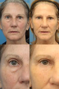 Dr. Francis Blepharoplasty Before & After Gallery - Patient 156740295 - Image 1