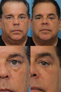 Dr. Francis Blepharoplasty Before & After Gallery - Patient 156740296 - Image 1