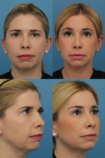 Dr. Francis Browlift Before & After Gallery - Patient 156740301 - Image 1