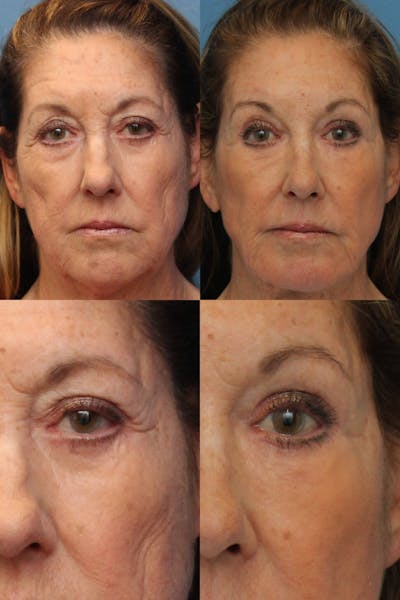 Dr. Francis Browlift Before & After Gallery - Patient 156740305 - Image 1