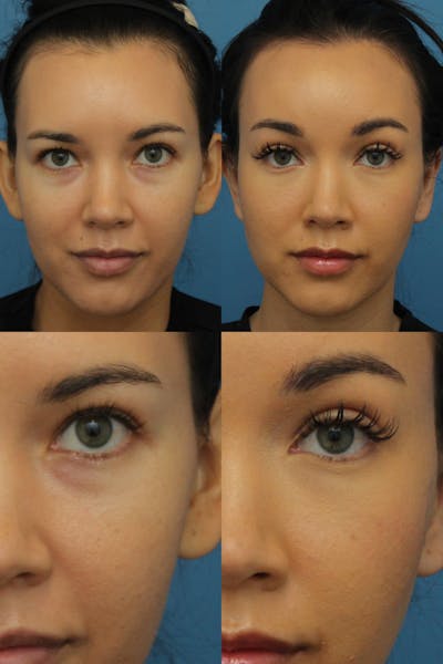Dr. Francis Browlift Before & After Gallery - Patient 156740306 - Image 1