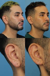 Dr. Francis Earlobe Reduction Before & After Gallery - Patient 156740316 - Image 1