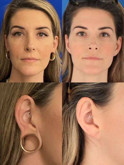 Dr. Francis Earlobe Repair for Gauged Piercings Before & After Gallery - Patient 156740352 - Image 1