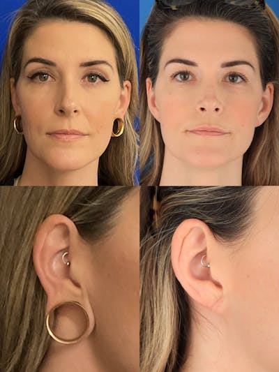 Dr. Francis Earlobe Repair for Gauged Piercings Before & After Gallery - Patient 156740352 - Image 1