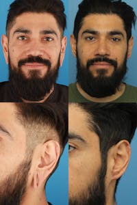 Dr. Francis Earlobe Repair for Gauged Piercings Before & After Gallery - Patient 156740353 - Image 1