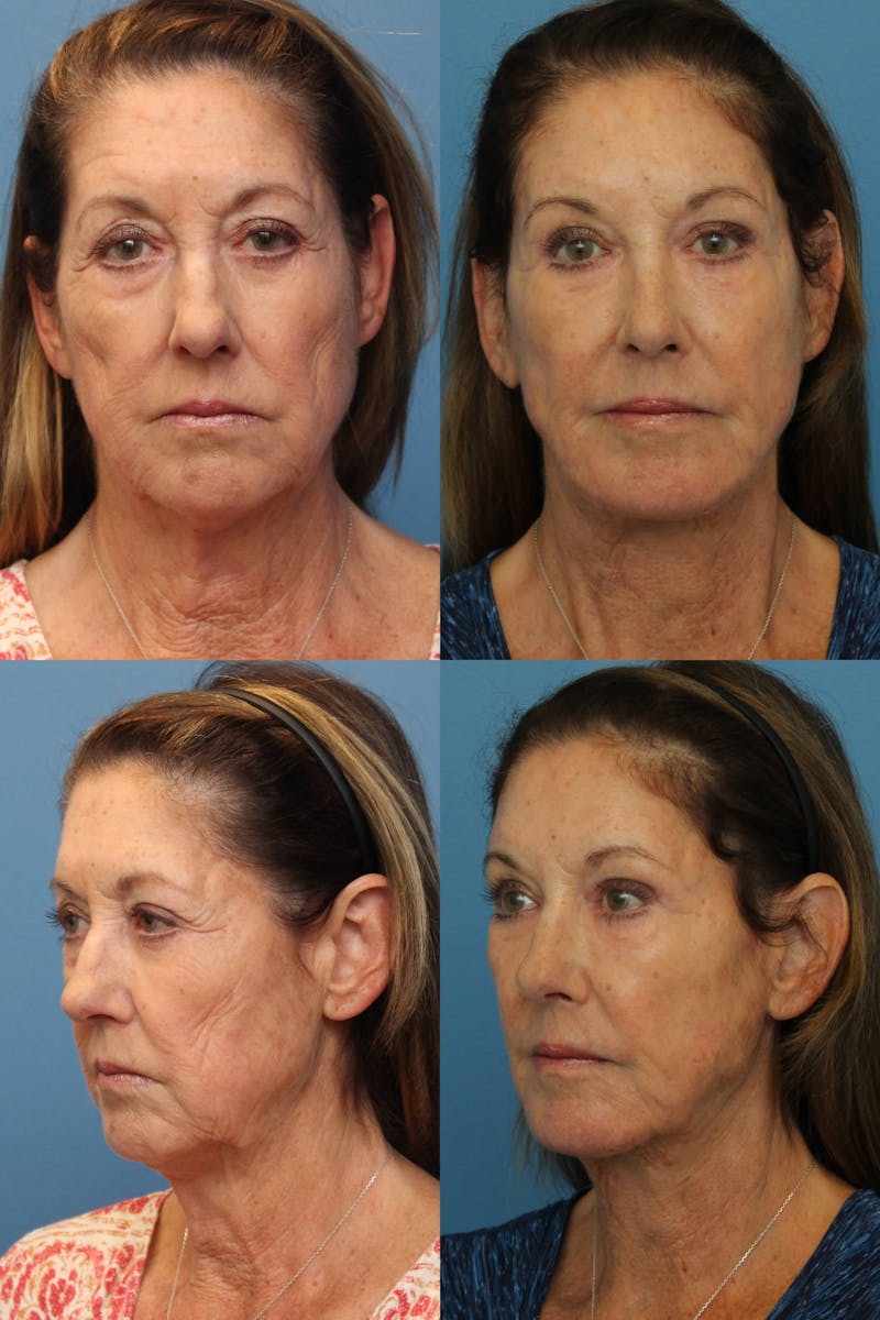 Dr. Francis Facelift Before & After Gallery - Patient 156740363 - Image 1