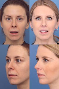 Dr. Francis Lip Lift Before & After Gallery - Patient 156740371 - Image 1