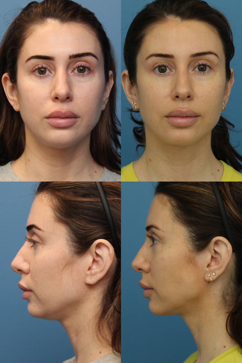 Dr. Francis Submental Liposuction Before & After Gallery - Patient 156740445 - Image 1