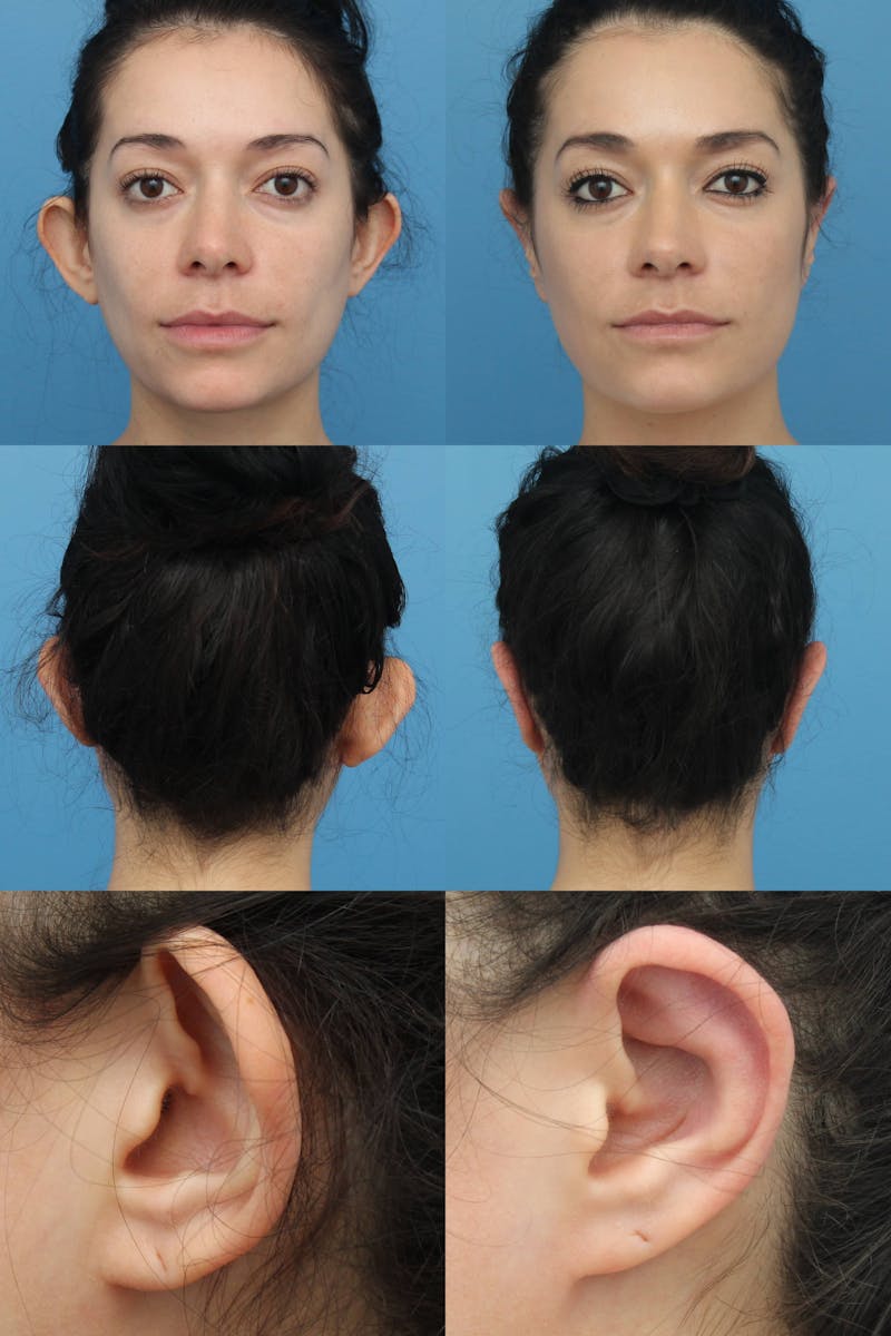 Dr. Francis Otoplasty Before & After Gallery - Patient 156740553 - Image 2