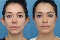 Dr. Francis Otoplasty Before & After Gallery - Patient 156740553 - Image 1