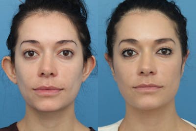 Dr. Francis Otoplasty Before & After Gallery - Patient 156740553 - Image 1