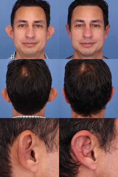 Dr. Francis Otoplasty Before & After Gallery - Patient 156740554 - Image 2
