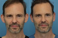 Dr. Francis Otoplasty Before & After Gallery - Patient 156740555 - Image 1
