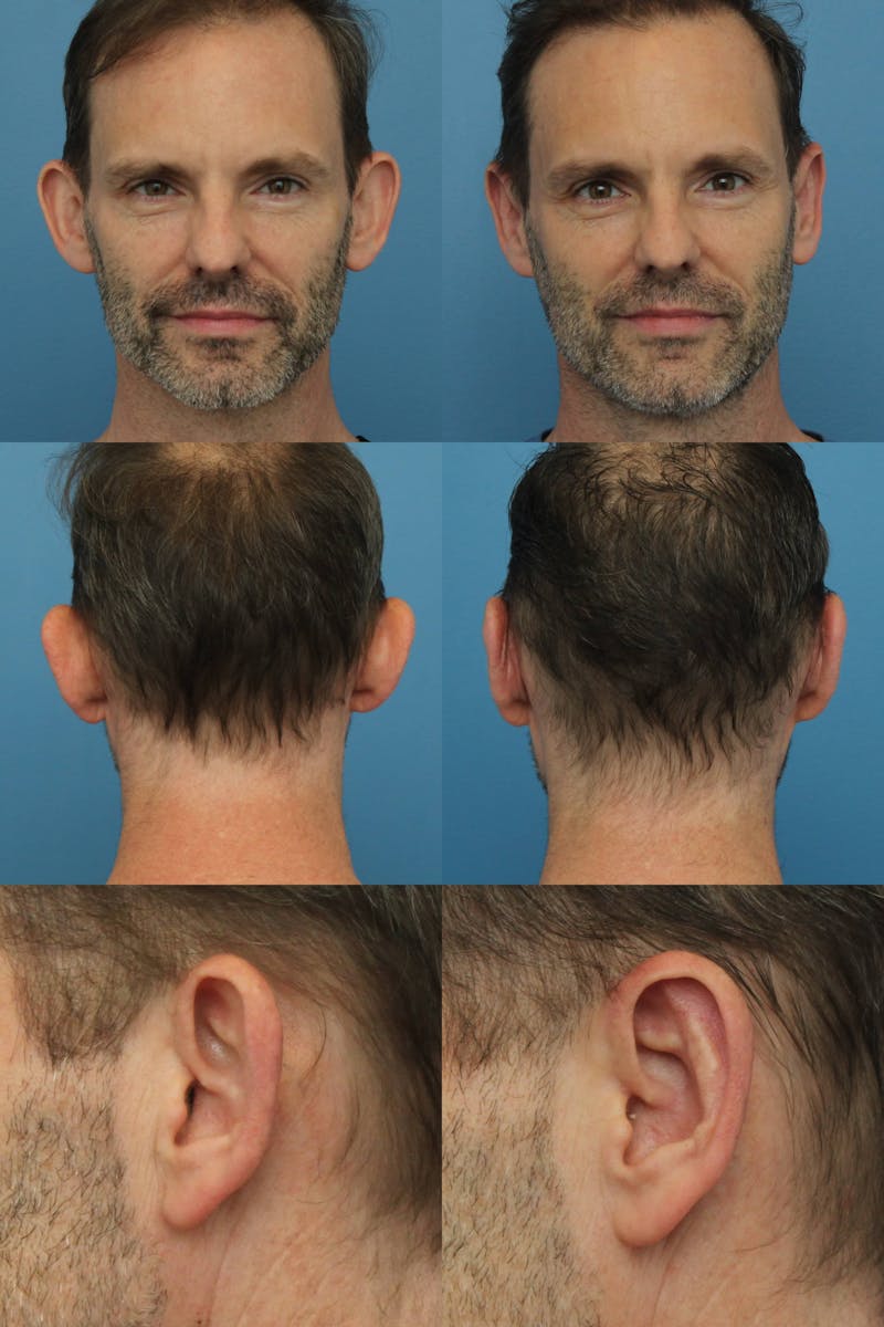 Dr. Francis Otoplasty Before & After Gallery - Patient 156740555 - Image 2
