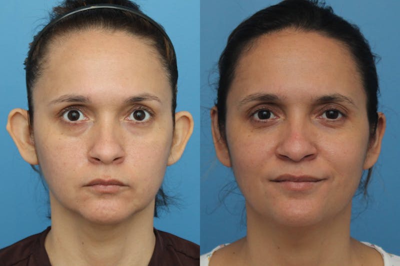Dr. Francis Otoplasty Before & After Gallery - Patient 156740556 - Image 1