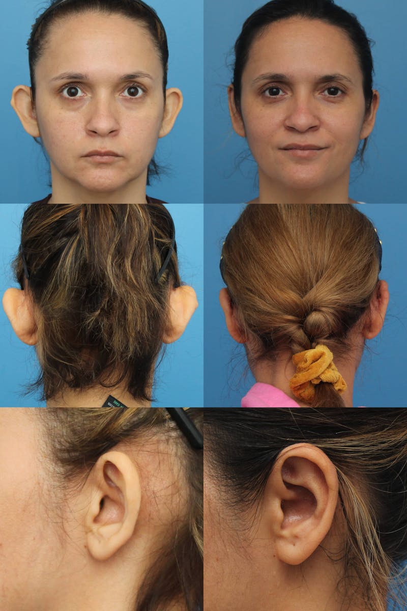 Dr. Francis Otoplasty Before & After Gallery - Patient 156740556 - Image 2