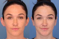 Dr. Francis Otoplasty Before & After Gallery - Patient 156740557 - Image 1
