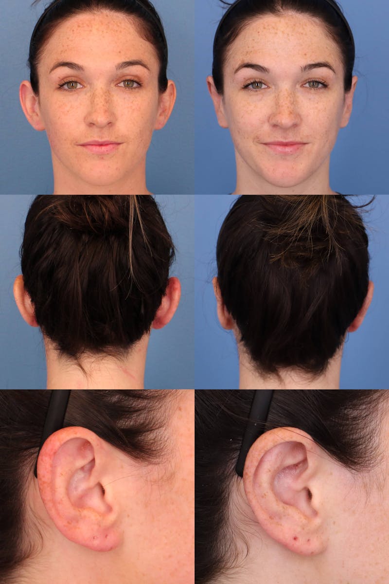 Dr. Francis Otoplasty Before & After Gallery - Patient 156740557 - Image 2